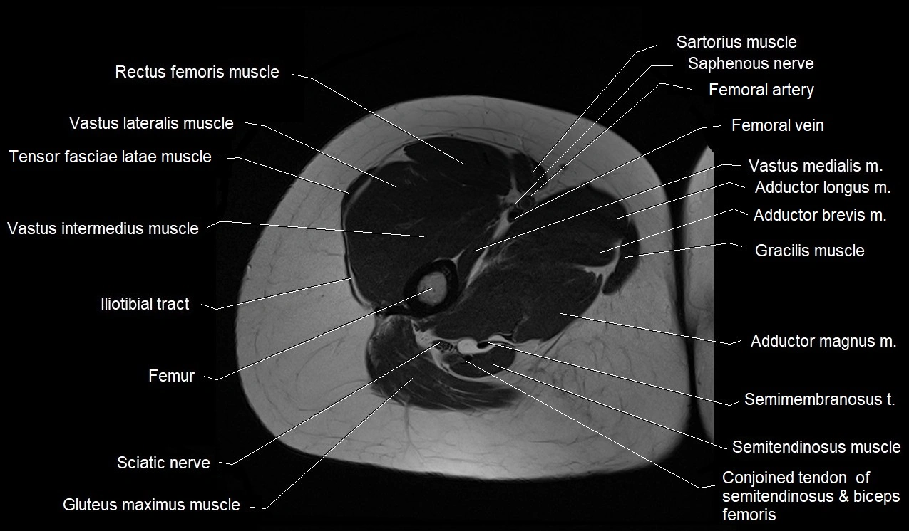 MRI thigh cross sectional anatomy image 18.webp